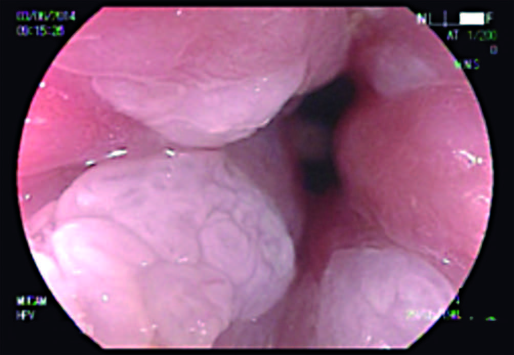 rectal cancer hpv papiloma doctor pleoapa