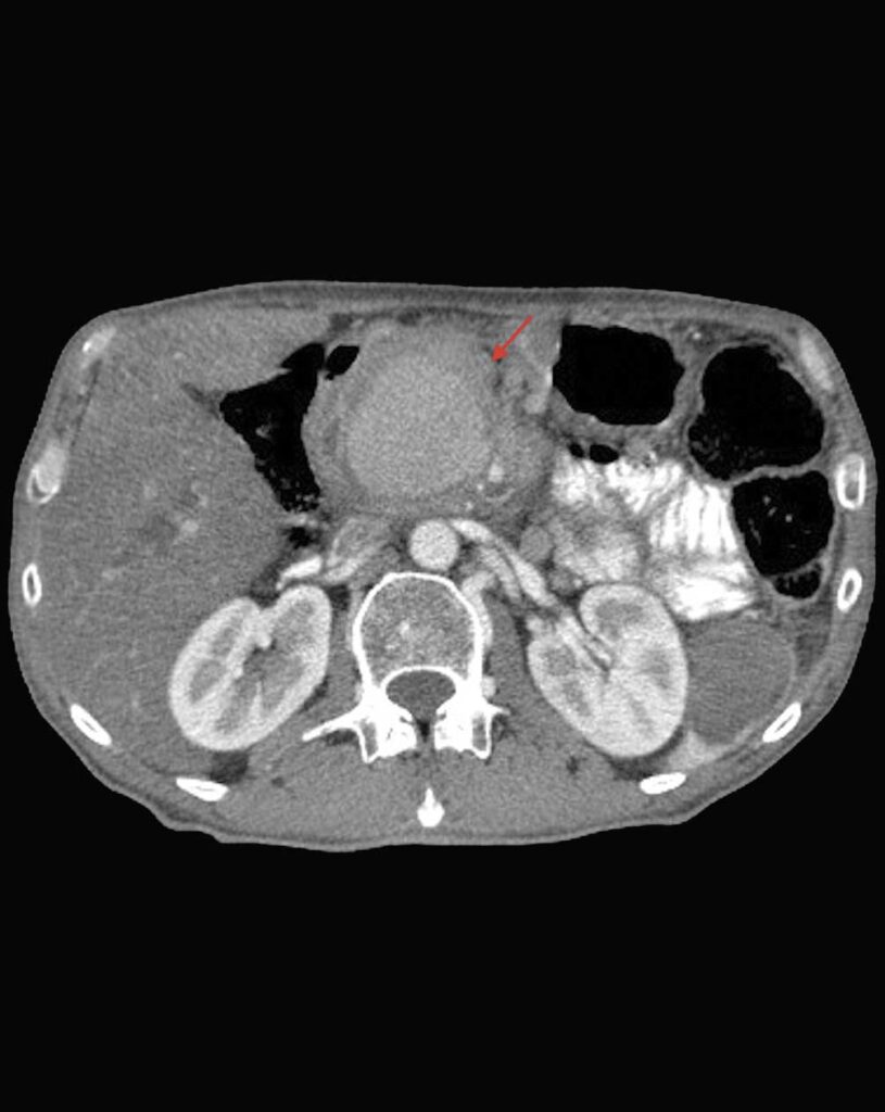 tomografia com contraste abdomen