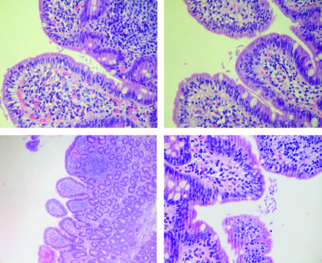 quistes de giardia en heces