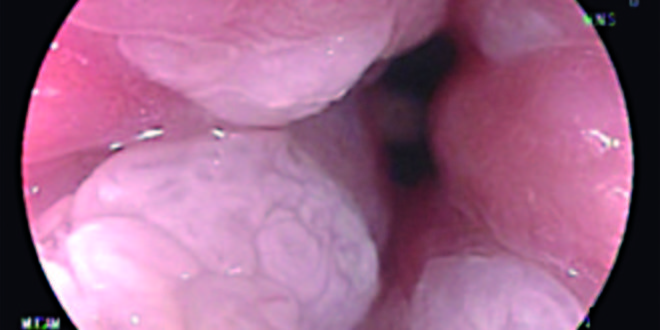 Ano con papiloma - Virus del papiloma humano cancer de ano - - Verrugas papiloma ano