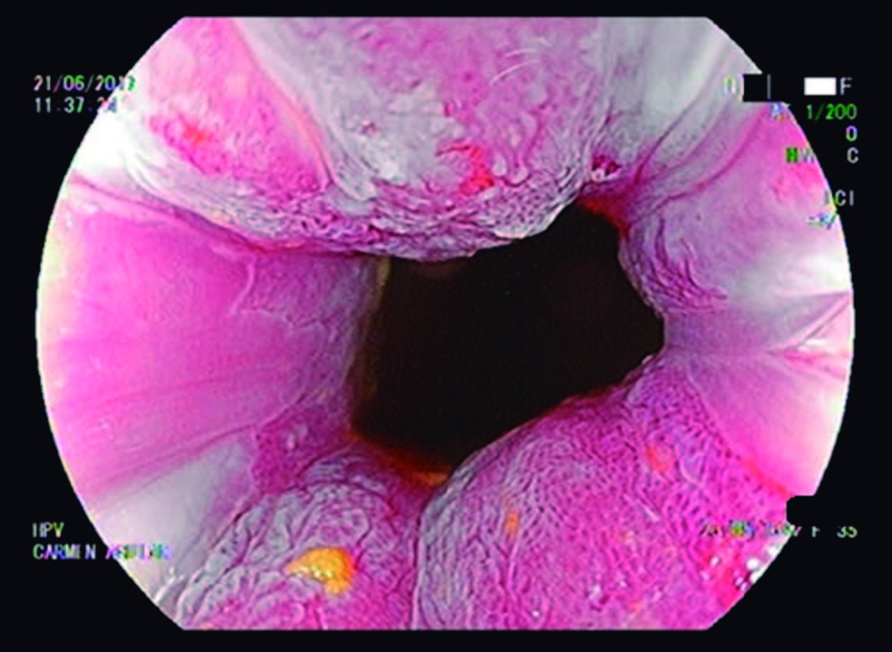 Papiloma rectal tratamiento, Tot ce trebuie sa stii despre HPV: Simptome & Tratament