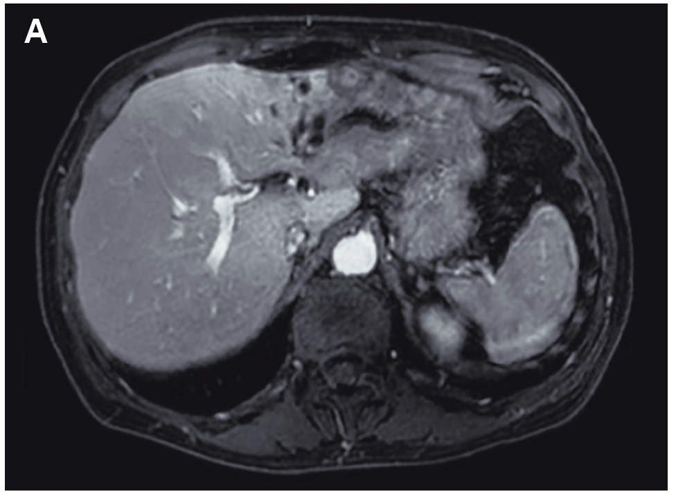 Hepatoesplenomegalia masiva en un paciente con enfermedad de