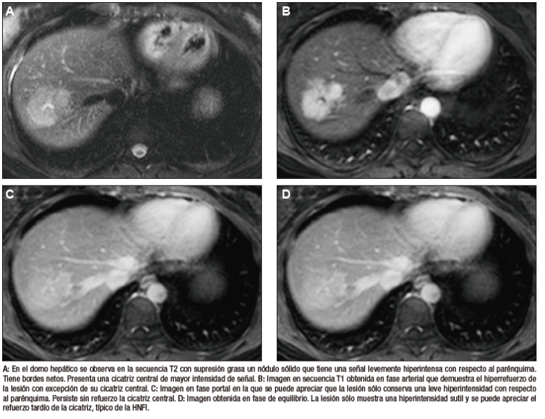 Lesiones Benignas Localizadas En El Hígado Desde La Mirada De Las Imágenes 5386