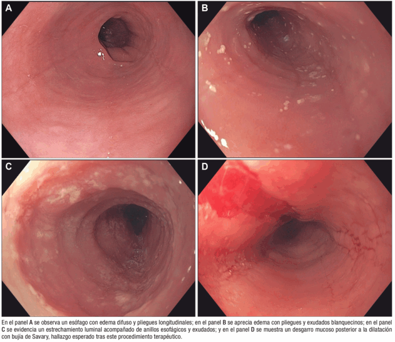 diagn-stico-y-tratamiento-de-la-esofagitis-eosinof-lica